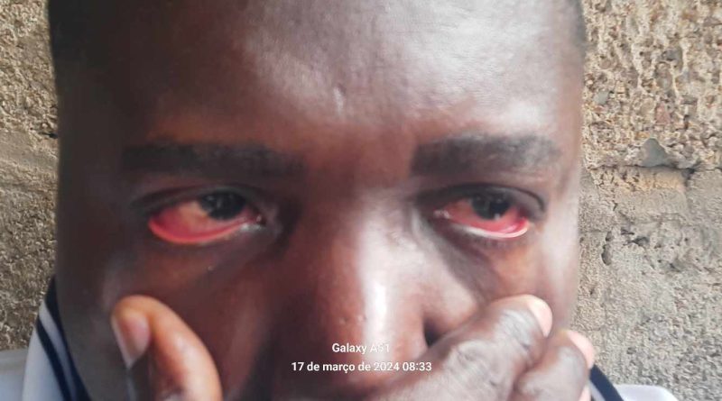 População de Cafunfo afectada com surto de conjuntivite hemorrágica-Jordan Muacabinza